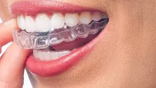 Cheap Braces Cost And Affordable Invisalign Deals In Akron Ohio