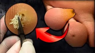 What is hiding inside?! 😱 Corns. Remove corns on the nails. Deep callus.Pedicure.MASSIVE CORN