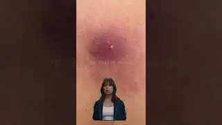 Infection season 2024 #skincare lipomaCyst clinic