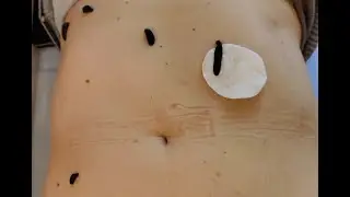 Комплексная Гирудотерапия 👩‍⚕️👉