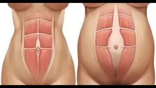 Rectus Diastasis - How To Get Rid of the Abdominal Bulge