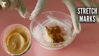 Use This If You Have Stretch marks!