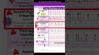 ECG (EKG) Rhythms to Know: Sinus Rhythms, Sinus Tachycardia, Heart blocks, etc.