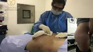 Male Brazilian Butt Lift Surgery in India (Buttock Augmentation Surgery)