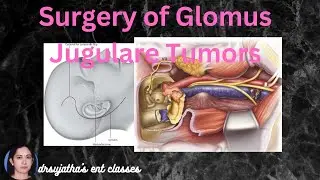240.Glomus Jugulare Tumors Treatment #surgeryeducation