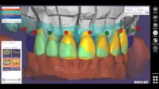 EXOCAD TUTORIAL 2016-1 -MODELLATION Chain-Mode / Ketten-Modus