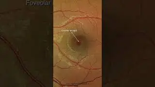 Solar Retinopathy #eyedisease #ophthalmology #retina #oct