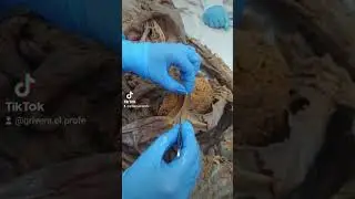 El ligamento falciforme
