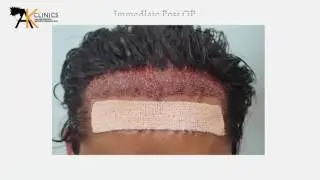 1300 Grafts Bio FUE Hair Transplant in India,  Result After 1 Year, Dr Kapil Dua India