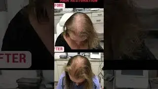 From laser tattoo removal, to prp for hair growth, we're here to help our patients! #cosmeticderm