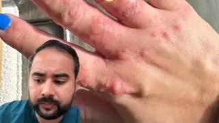 Horrible hand foot mouth disease