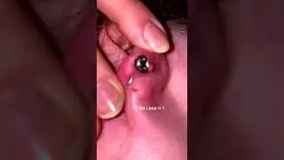 Black head removal on face - Blackheads on back treatment