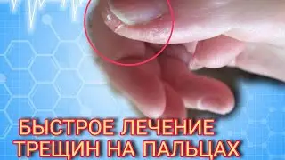 Лечим трещины возле ногтя