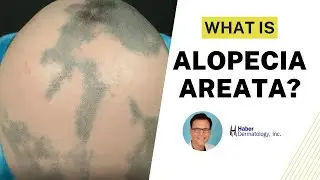 What is Alopecia Areata? Causes, Treatment & Hair Regrowth | Robert Haber, MD