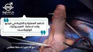 شاهد العملية و النتيجة في فيديو واحد لدعامة الهيدروليك الكوبلاست \ مع الدكتور اسامة غطاس