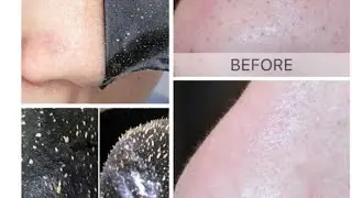 Easy Way To Remove Blackheads❤️✨ |Priya Creations|