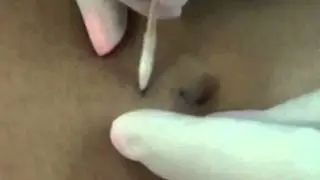 ☊ Navel Piercing ☊ After a Surgical