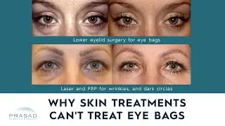 Why Non-Surgical Lasers and Skin Treatments are Not Effective for Puffy Eye Bags