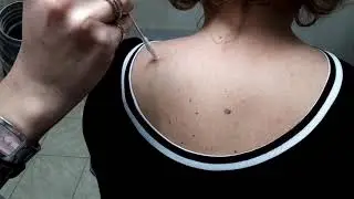 Криодеструкция кератомы на теле
