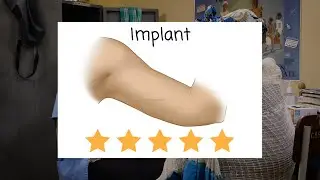 The Implant (Health Workers) - Family Planning Series