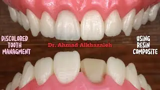Discolored Tooth Management Using Dental Composite - Polychromatic Layering with Finishing Steps