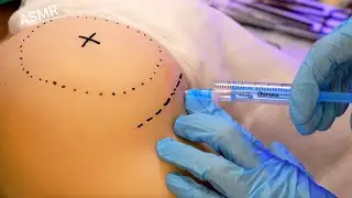 Hyper-Realistic BBL & Gluteal Implants Surgery on Tantaly Doll | ASMR
