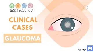 Glaucoma Clinical Case