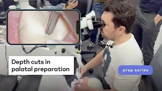Depth cuts in palatal preparation