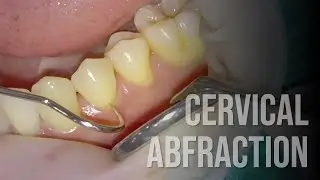 Class V Composite Restoration