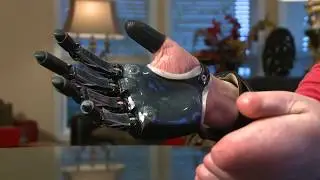 Electric Fingers Give Hope to Bilateral Amputee