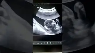 Бош мия томир чигали кистаси