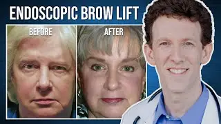 Minimal Incision Brow Lift | Cheryl's Testimonial