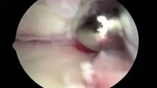 Ankle Arthroscopy