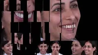 חיוך חדש לפני ואחרי - טיפול מתקדם במרכז סביון להשתלות שיניים