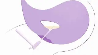 LoFric Elle - Step by Step Animation Animated IFU