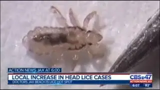 Increase in head lice cases in Jacksonville
