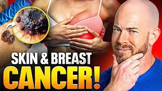 SHOCKING Link Between Breast Cancer and Skin Cancer Exposed!