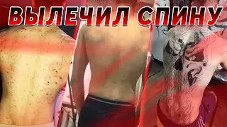 ГНИЛАЯ СПИНА. Как я вылечил кожу и комплексы :)