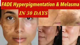 30 Days challenge | Get Rid of Dark spots Melasma & Pigmentation /💯% Results