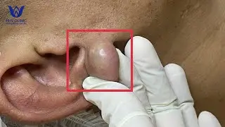 NẶN MỤN NHỌT ( VIÊM TỤ CẦU ) VÙNG TAI - TẠI PHÒNG KHÁM DA LIỄU HHV CLINIC