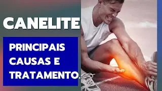 Canelite: Principais causas e como aliviar.