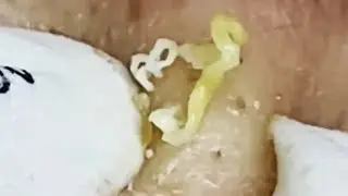 Blackheads & Whiteheads Satisfying Removal @0238