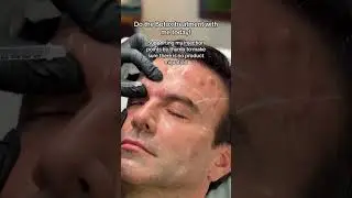 forehead botox for men's #botox #menbotox #foreheadwrinkles #shorts