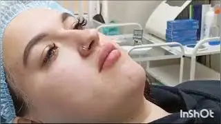 Удлинение подбородка с помощью филлера.