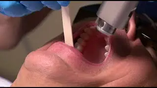 Doctors pioneering therapy to combat snoring