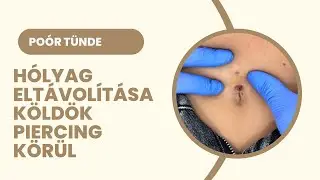 Köldök piercing körül kialakult hólyag eltávolítása