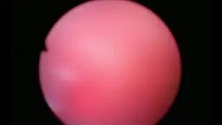 HoLEP. Оператор:  Болгов Е.Н. EndoUroCenter.