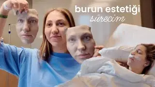 BURUN ESTETİĞİ OLDUM! | ameliyat günü, 3D maske, tüm sürecim (kapalı rinoplasti)