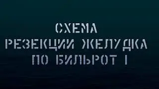 Схема резекции желудка по Бильрот I