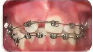 A time-lapse of bracers doing their best job